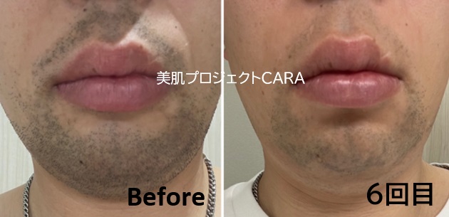 脱毛って痛い?どれくらいの期間通うの?